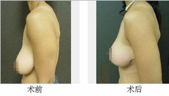 女人乳房下垂,女性乳房下垂:原因及解决方法