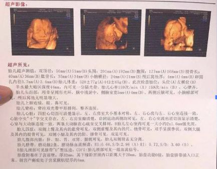 原创孕期检查时，B超单上如果有3种“情况”，可能会生下“男宝宝”