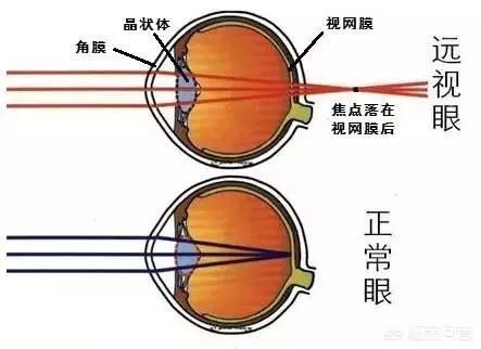 中国青少年近5年的近视率 远视率 散光率分别是多少