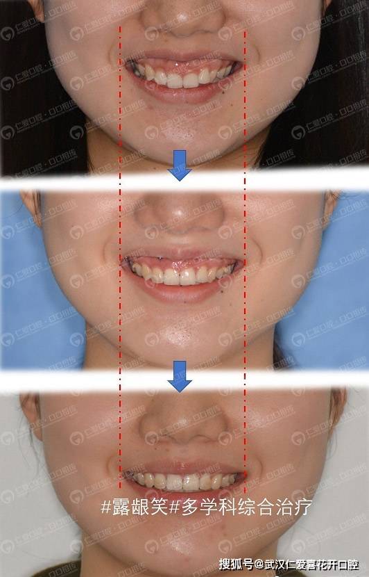 武汉仁爱口腔 龅牙嘴突,露龈笑 牙齿矫正告诉你这些都还有救