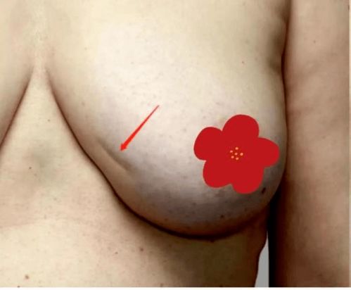 乳房侧面摸到一坨大的硬块