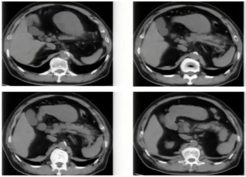 看得懂这些腹部CT,主任一定对你刮目相看
