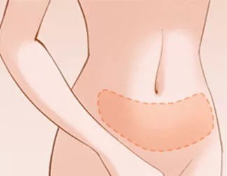 吸脂手术原理是什么 直击腹部吸脂手术全过程