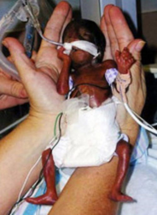 阿米利娅 泰勒 世界最小婴儿阿米利娅