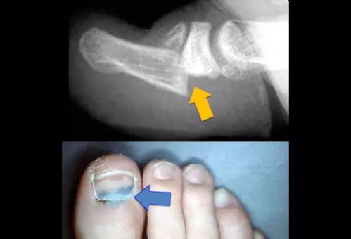 右手环指末节开放性骨折 文章阅读中心 急不急图文 Jpjww Com