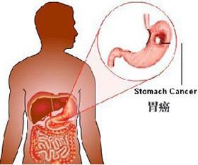 刘学谦 饮食与胃癌发病的关系