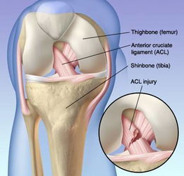 左膝盖韧带撕裂图片 搜狗图片搜索