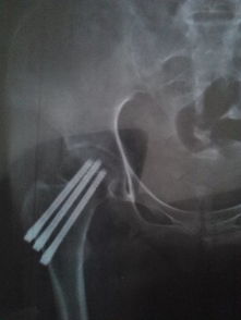股骨颈骨折可以不取钢针嘛,还有就是这个恢复的怎么样了,已经8个月了 