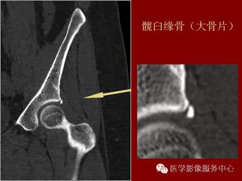 易误认为骨折的骨骺