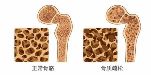 吃钙片的最佳时间被发现 医生 吃错了时间影响效果,别大意