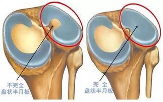 半月板损伤如何治疗