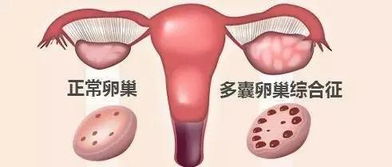 【秒懂科普|第325期】多囊卵巢综合征的运动管理