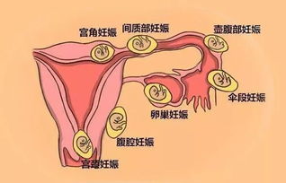 宫外孕后,我还能够自然怀孕吗