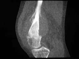 左股骨下段骨肉瘤 osteoma sarcomatosum 图文