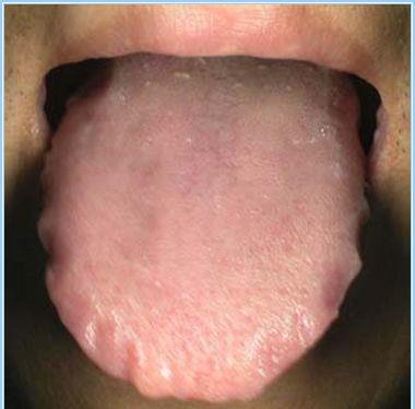 舌上有齿痕，舌头上有齿痕是什么原因怎么改善