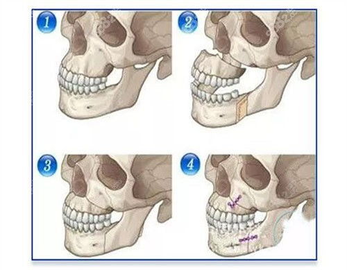 上海九院颌面整形价格表更新,看正颌 下颌骨手术多少钱