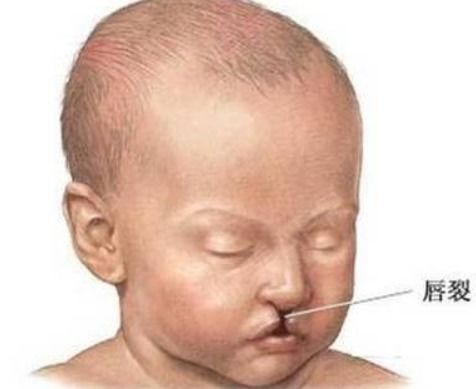 涨知识 预防宝宝长兔唇,妈妈们该如何做