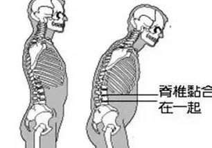 强直性脊柱炎得新冠会有后遗症吗（新冠 强直性脊柱炎） 第1张