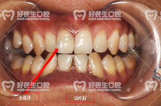 好民生口腔 一颗门牙的 风水 说 前牙美学修复助其事业形象双提升