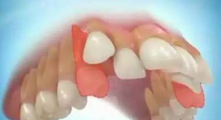株洲口腔科医生,牙齿正畸为什么要拔牙 请给我一个说法