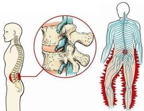 才18岁就腰间盘突出,没想到几天就开始缓解,治腰突的一个好方法 