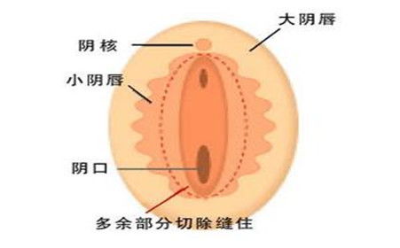 阴唇整形术 让爱更完整