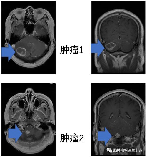 肺癌转移到脑部的多发肿瘤可以手术吗