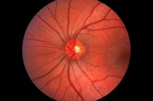 视网膜色素变性的诊断与治疗 