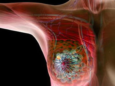 乳腺癌晚期患者还能活多久