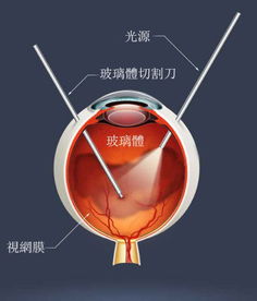 注意 糖尿病可造成不可逆的视力损失,这7种症状需提前警惕