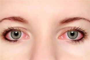 红眼病是怎么引起的 会传染吗,病因有哪些呢 