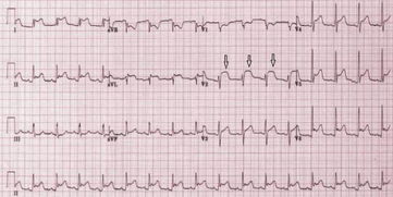ST段弓背向上抬高甚至成单向曲线意思？希望给图说明。