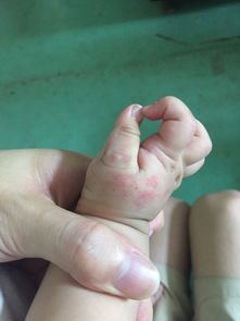 宝宝的手被蚊虫咬了一口 变成这样了 