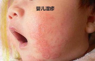 原创大家对于湿疹，热疹又了解多少呢，什么是婴儿热疹？