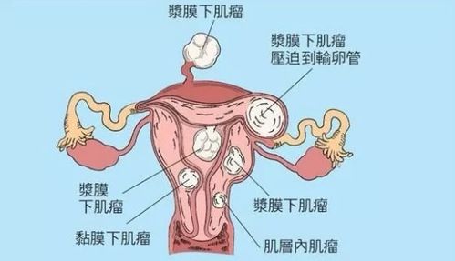 女子因子宫肌瘤切除子宫后八个月突然怀孕有可能吗