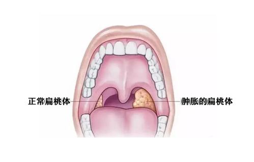 正常扁桃体图片大全 