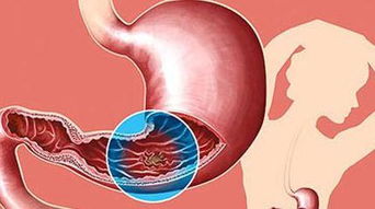 胃痛都是病,你知道自己属于哪种胃病吗