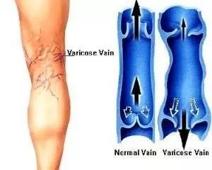 静脉曲张不治疗会越来越严重吗对身体健康会造成什么样的影响