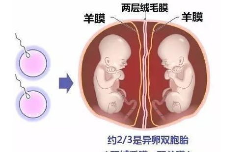 怀了双胞胎 14周前一定要明确这件事