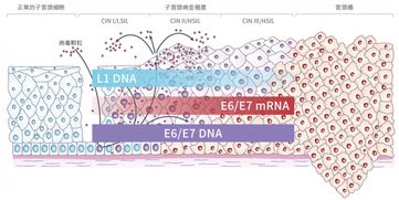 人乳头瘤病毒（6.11型）DNA测定 检测结果：1.63E+05 检测下限：＜500基因拷贝/ml 这正常么？是否感染？