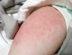 幼儿急疹图片(幼儿急疹症状及图片)