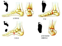 扁平足影响寿命吗 扁平足会死吗 扁平足能活多久 