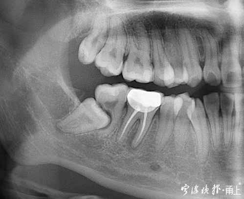 拔智齿上热搜 智齿到底该不该拔 宁波口腔科医生这么说 