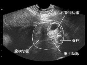 肾长了一个错构瘤，错构瘤破裂了会导致尿血吗(肾错构瘤会长大吗 好大夫)