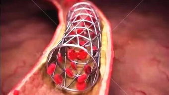 做心脏支架的问题
