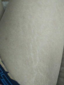我大腿上这是什么纹 好像肉裂开了.. 