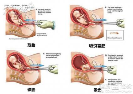 怎样处理流产比较安全稳妥呢