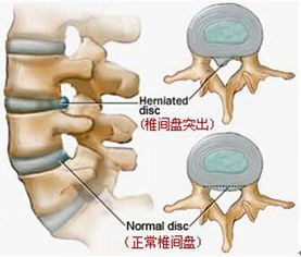 腰椎间盘突出症的治疗偏方