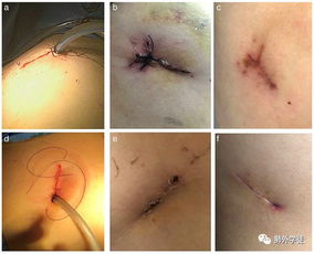 微创切口免拆线缝合
