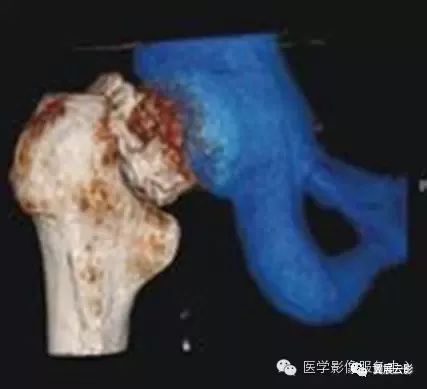 口诀巧记 看不见骨折线的骨折,这样读片 医学影像